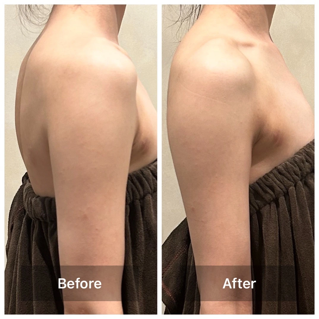 横から撮影した肩まわりのBefore・After比較写真。左がBefore、右がAfter