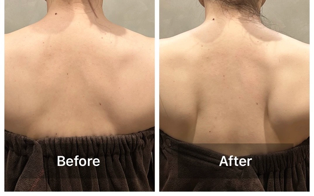 背中側から撮影した肩まわりのBefore・After比較写真。左がBefore、右がAfter